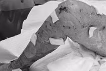 Nữ bệnh nhân 67 tuổi mắc hội chứng Lyell - bệnh lý hiếm gặp