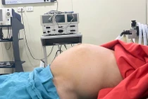 Người phụ nữ mang khối u xơ tử cung nặng gần 10 kg