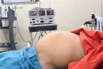 Người phụ nữ mang khối u xơ tử cung nặng gần 10 kg