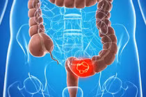 Ung thư đại trực tràng trẻ hóa, nguy cơ ngày càng gia tăng ở Việt Nam