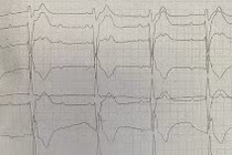 Cứu sống người đàn ông trẻ tim đập hơn 200 nhịp/phút, huyết áp tụt sâu