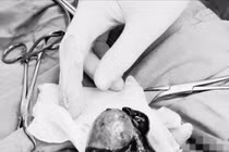 Thanh niên 20 tuổi phải cắt 1 bên tinh hoàn do xoắn tinh hoàn nhập viện muộn