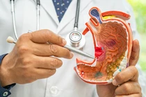 Người đàn ông ở Hà Nội đi khám đầy bụng, phát hiện ung thư dạ dày