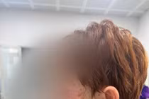 Bác sĩ lưu ý chứng tổn thương da nặng do mắc virus Herpes simplex