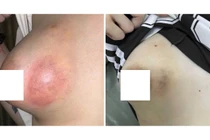 Cô gái 20 tuổi bị áp xe vú nặng sau khi tiêm chất làm đầy không rõ nguồn gốc