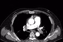 Cứu sống nam bệnh nhân 51 tuổi bị thuyên tắc phổi nguy kịch