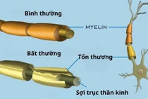  Người đàn ông ở Đắk Lắk mắc hội chứng hiếm Guillain-Barré