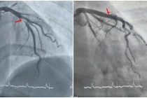 Bệnh nhân 29 tuổi phát hiện nhồi máu cơ tim qua điện tim trước nội soi