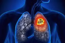 Dấu hiệu sớm cảnh báo ung thư phổi, cách phòng tránh
