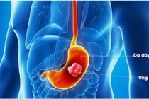 Tầm soát sớm ung thư dạ dày để không bỏ lỡ 'thời điểm vàng'