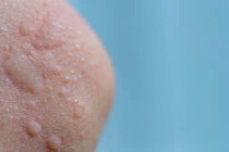 Giữ ấm cơ thể, phòng ngừa bệnh mày đay do lạnh