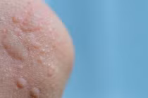 Giữ ấm cơ thể, phòng ngừa bệnh mày đay do lạnh