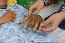 Cứu sống nam thanh niên 27 tuổi bị rắn chàm quạp cắn