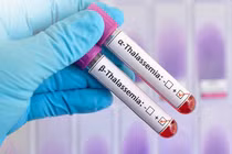Phát hiện trẻ 19 tháng tuổi mang đột biến gene Thalassemia