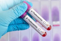 Từ dấu hiệu thiếu máu, phát hiện trẻ mắc bệnh Thalassemia