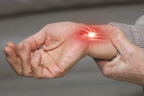 Phát hiện sớm hội chứng ống cổ tay, tránh tổn thương lâu dài