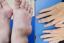 Nam thanh niên biến dạng tay chân nặng do biến chứng của bệnh gout