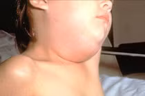 Nhận biết sớm dấu hiệu bệnh quai bị ở trẻ em giúp hạn chế biến chứng