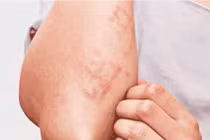 Số ca nhiễm giun đũa chó mèo tại Khánh Hòa tăng cao trong hơn 1 tháng qua