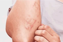 Số ca nhiễm giun đũa chó mèo tại Khánh Hòa tăng cao trong hơn 1 tháng qua