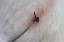 Con vắt dài 3cm ký sinh trong mũi cô gái 21 tuổi 