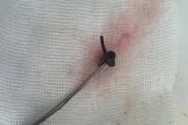 Con vắt dài 3cm ký sinh trong mũi cô gái 21 tuổi 