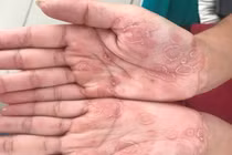 Bé trai 3 tuổi phát hiện bị giang mai bẩm sinh khi đi khám sàng lọc