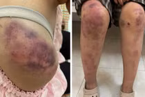 Sức khỏe bé gái ở Thái Nguyên bị bà nội và 2 người đàn ông bạo hành