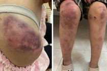 Sức khỏe bé gái ở Thái Nguyên bị bà nội và 2 người đàn ông bạo hành