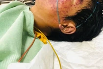 Người đàn ông ở Lạng Sơn nguy kịch do ăn 'món khoái khẩu'