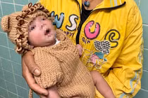 Trẻ sơ sinh 5 ngày tuổi bị thủng dạ dày, nhiễm khuẩn huyết vì mẹ cho ăn cơm