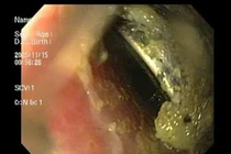 Cứu bé trai gần 3 tuổi nuốt pin cúc áo loét thực quản