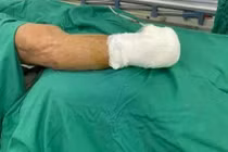 Cụ ông phải cắt cụt chi dưới vì xơ vữa động mạch gây tắc, hoại tử