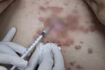 Bị áp xe nghiêm trọng khi tiêm chất làm đầy kém chất lượng