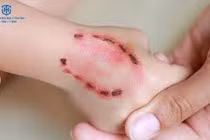 Bé 8 tuổi suy hô hấp, tổn thương não sau 5 tháng bị chó cắn