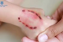 Bé trai ở Vĩnh Phúc mắc bệnh dại sau 5 tháng bị chó cắn