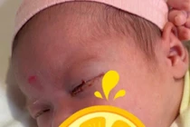 Bé gái 18 ngày tuổi mắc viêm kết mạc sơ sinh nặng