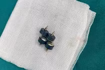 Bệnh nhi 2 tuổi ở Nghệ An nuốt 4 viên đinh nam châm đầu nhọn nguy hiểm