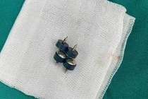 Bệnh nhi 2 tuổi ở Nghệ An nuốt 4 viên đinh nam châm đầu nhọn nguy hiểm