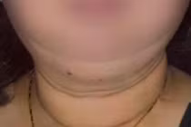 Cơ thể người phụ nữ “biến dạng” do lạm dụng thuốc corticoid