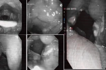 Viêm amidan cấp mủ có thể gây nhiều biến chứng nguy hiểm 