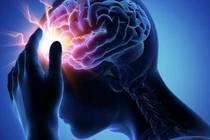 Đau thần kinh chẩm, nguyên nhân thường gặp gây đau đầu kéo dài