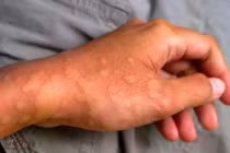 Nguyên nhân nổi mề đay, cách phòng tránh