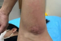 Người phụ nữ 38 tuổi ở Hà Nội bị áp xe chỉ từ vết xước nhỏ ở nách