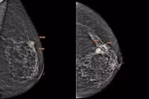 Cụ bà 75 tuổi bất ngờ khi phát hiện ung thư vú giai đoạn xâm nhập