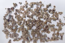 Phẫu thuật thành công ca sỏi thận san hô phức tạp cho người phụ nữ ở Nghệ An