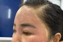 'Làm đẹp cấp tốc' đón Tết, người phụ nữ hỏng khuôn mặt