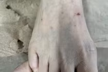 Người phụ nữ phải nhập viện do bôi nước chanh lên vết thương mèo cắn 