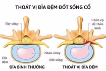 Thay nhân đĩa đệm nhân tạo giúp nam thanh niên thoát nguy cơ liệt tứ chi