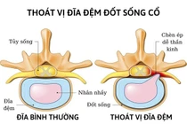 Thay nhân đĩa đệm nhân tạo giúp nam thanh niên thoát nguy cơ liệt tứ chi